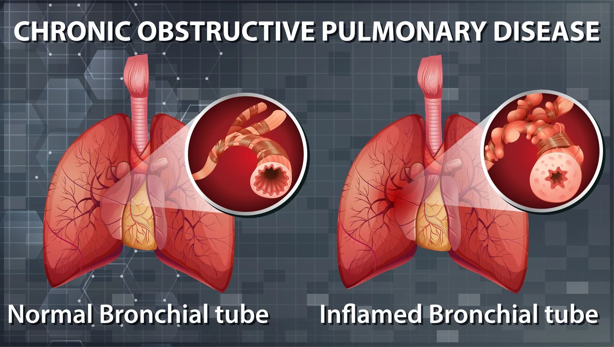 What is COPD? - Chronic Obstructive Pulmonary Disease