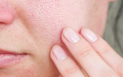 Causes of Dry Skin from Oxygen Therapy